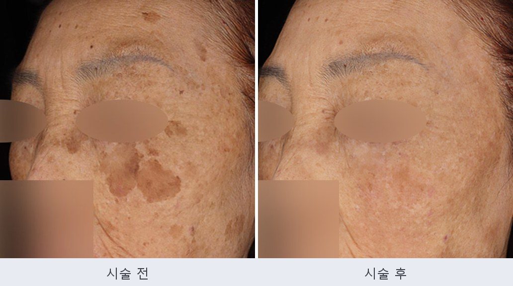 흑자 기미