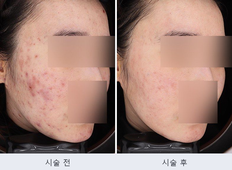 여드름 붉은자국